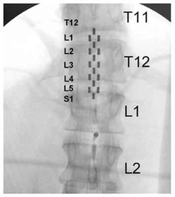Normalization of Blood Pressure With Spinal Cord Epidural Stimulation After Severe Spinal Cord Injury